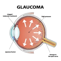¿Qué causa el glaucoma?